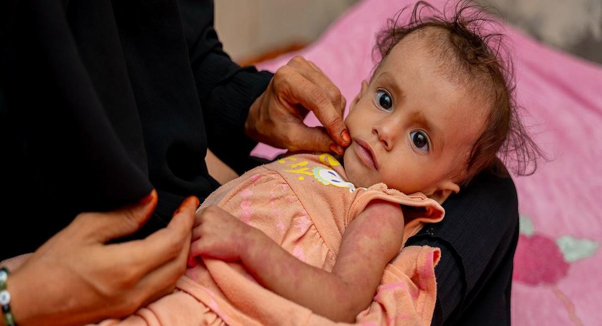 Una madre sostiene a su hija de 10 meses que padece retraso en el crecimiento y desnutrición en Abyan, Yemen. | Foto:  UNICEF/Saleh Hayyan