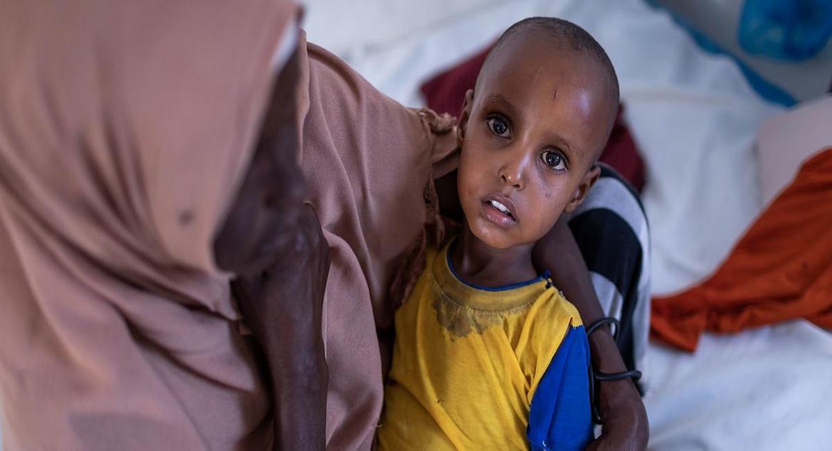 Uno de los 33 millones de niños que sufren desnutrición grave es tratado en un hospital de Somalilandia. | Foto: UNICEF/Mulugeta Ayene