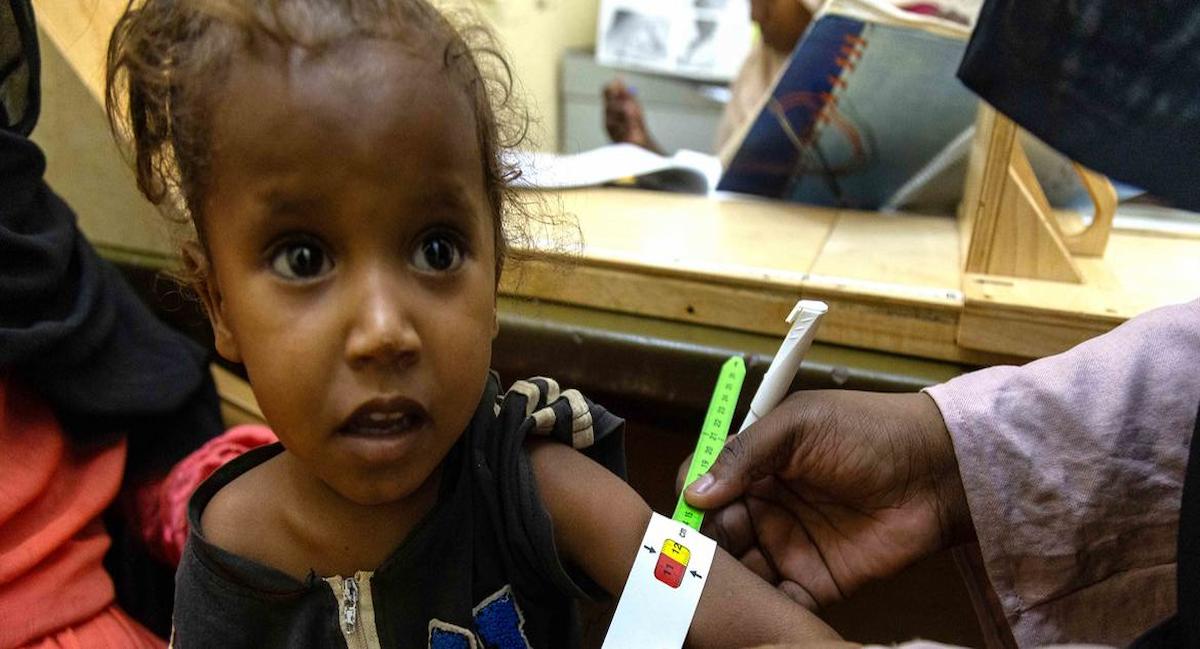 Una niña recibe tratamiento para la desnutrición en el hospital saudita de Omdurman, en el estado de Jartún, en Sudán. | Foto: UNICEF/UNI779530/Ahmed Mohamd