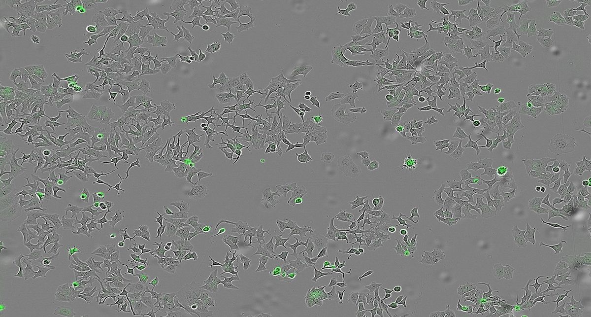 La imagen representa las células de cáncer muertas al activarse su proteína de membrana PAR-1 por la proteasa bacteriana HapA./CIC.