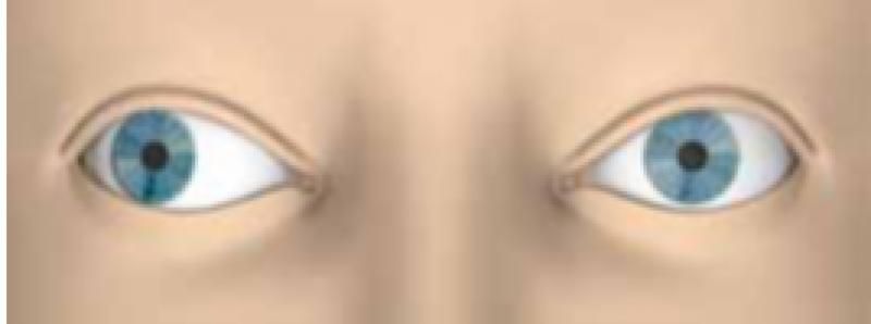 Esttrabismo funcional