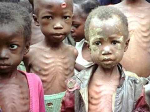 foto desnutrición infantil